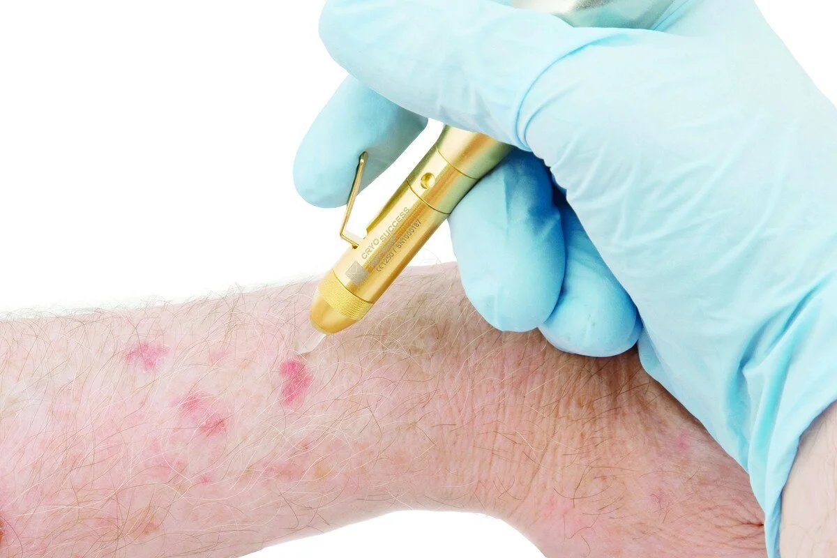 Cryotherapy pen treatment being applied to skin blemishes on a forearm
