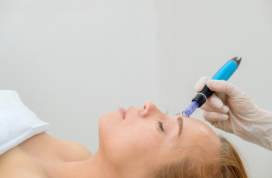 Microneedling treatment being performed on a client's forehead